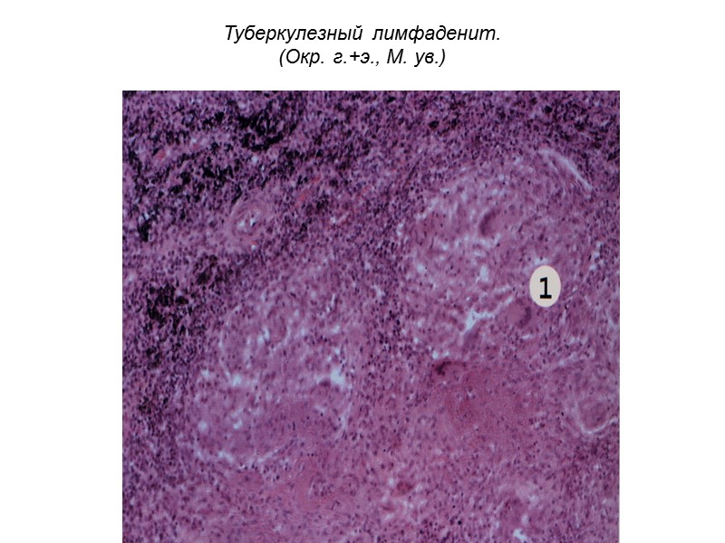 Туберкулезный лимфаденит.  (Окр. г.+э., М. ув.)